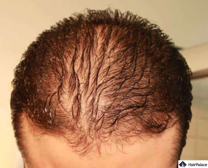 disruption of the hair growth cycle can lead to hair loss