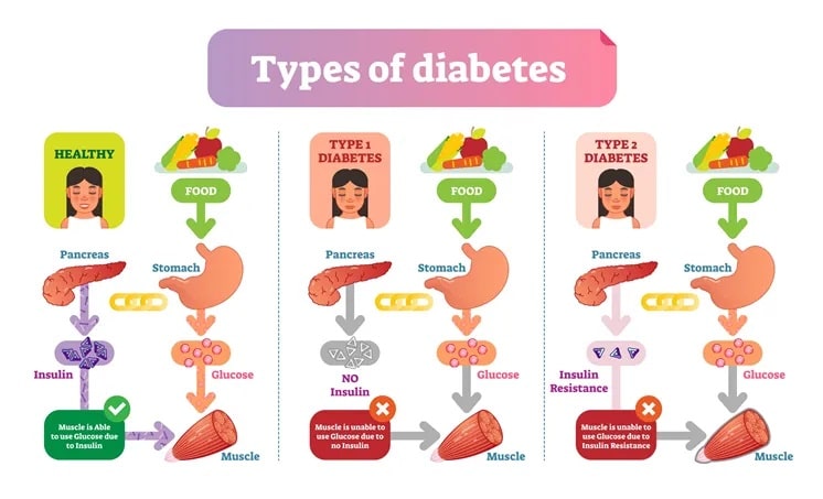 Diabetes hair loss can be caused by both types 1 and type 2