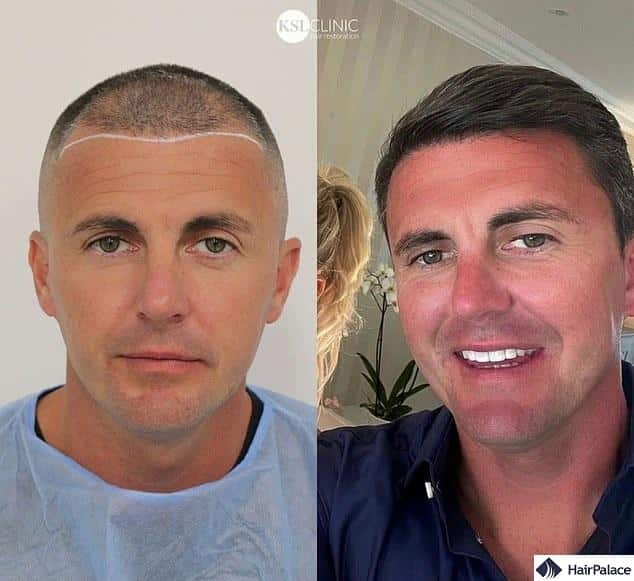 Billie Faiers husband Greg Shepherd hair transplant before and after