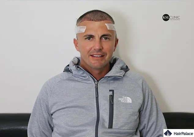 Greg Shepherd after his fue hair transplant