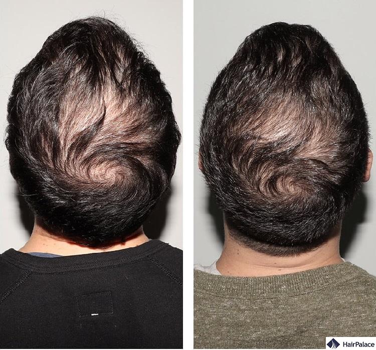 Nutrafol for men results