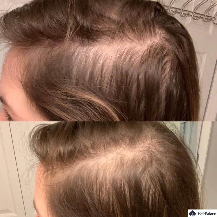 Nutrafol can stimulate hair regrowth