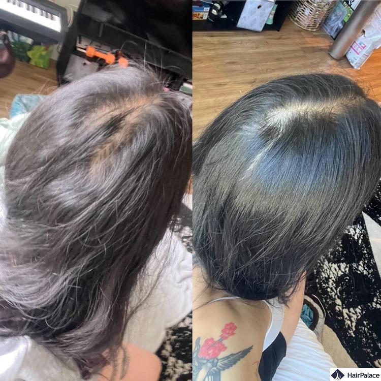 Nutrafol combats diffuse hair loss