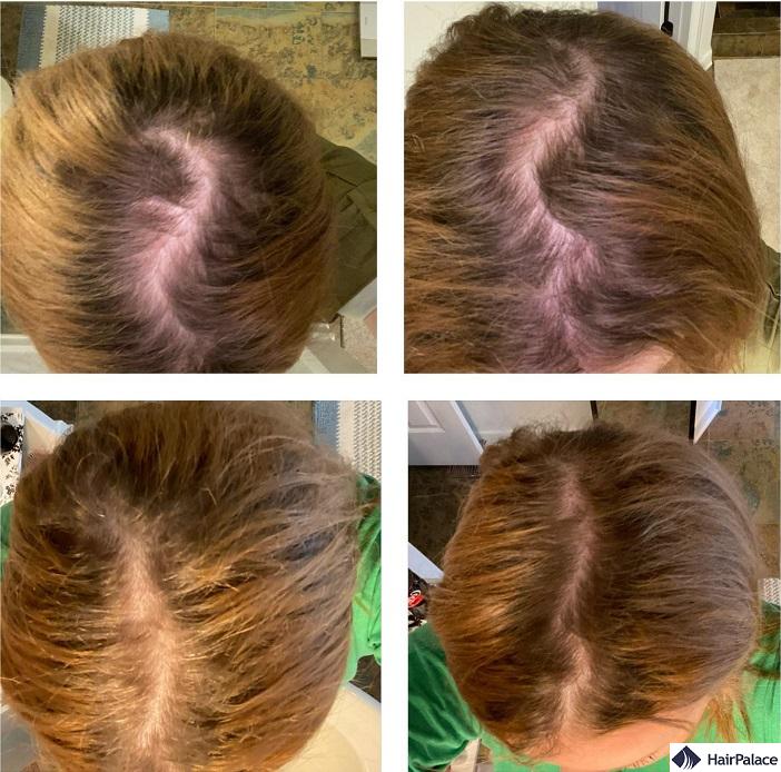 Nutrafol can regrow hair