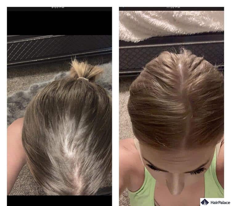 Nutrafol for women as a hair loss treatment