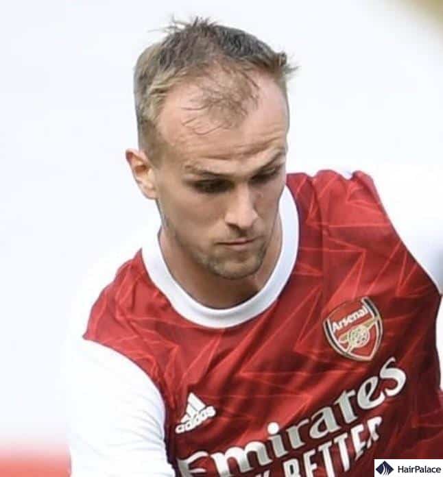 rob holding before hair transplant