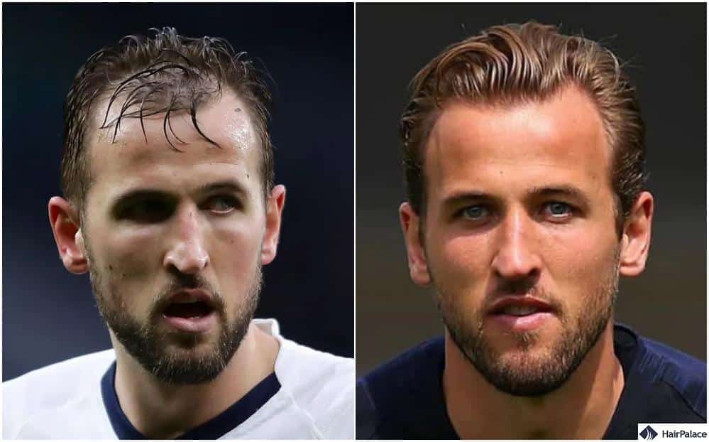 harry kane hair transplant result