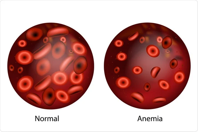 anemia hair loss happens due to iron deficiency