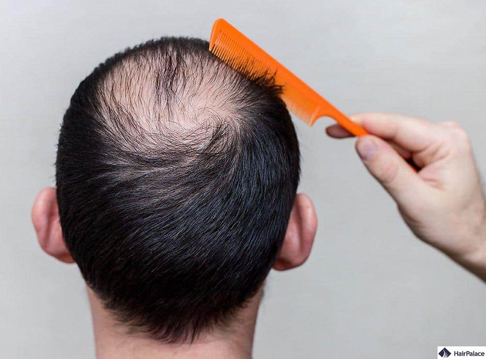 anemic hair loss