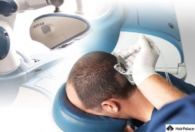 ARTAS robotic hair restoration