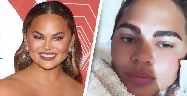Chrissy Teigen before and after her eyebrow transplant 