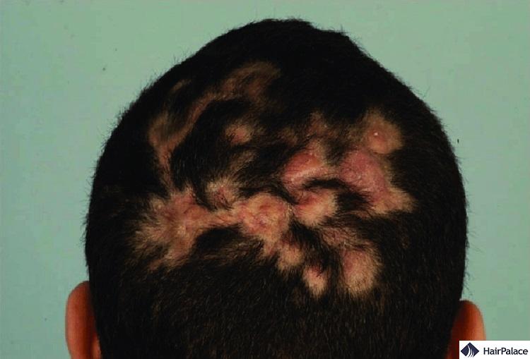 Scalp Infections | Types, Symptoms, and Treatments (2023)