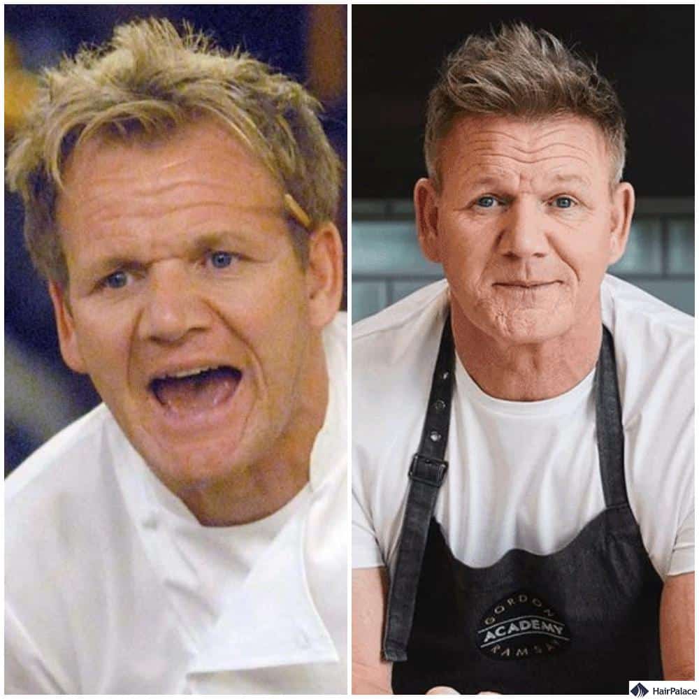 Gordon Ramsay before hair transplant and after the procedure