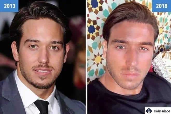 James Lock hair transplant before and after photos