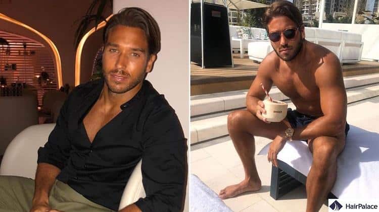 James Lock was on holiday after his hair transplant