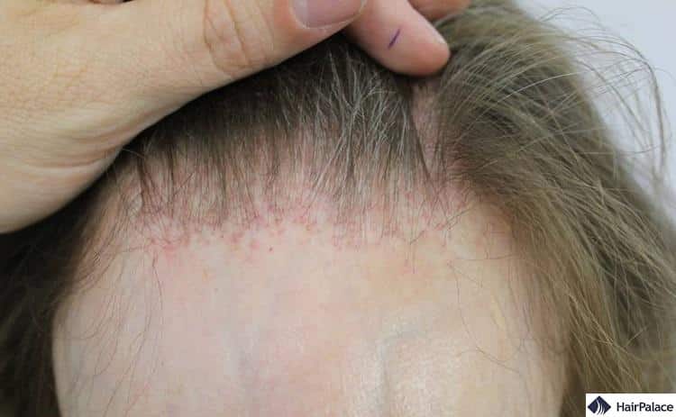 Lichen planus is a skin condition that can lead to hair loss