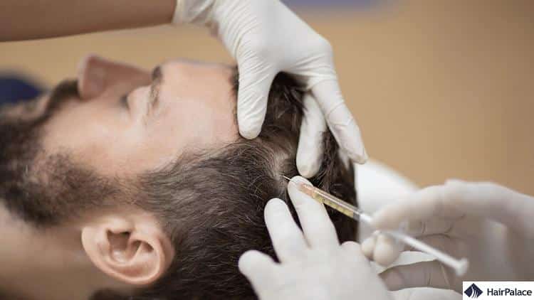PRP treatment may treat DHT hair loss