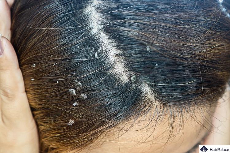 seborrheic dermatitis can lead to inflamed skin and hair thinning