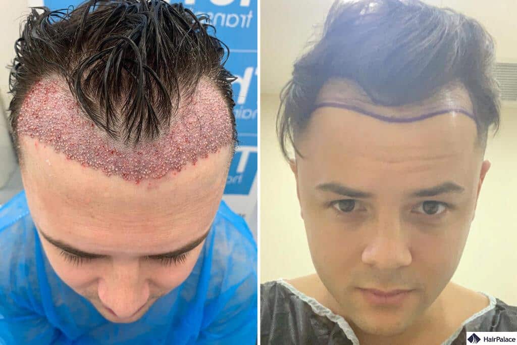 Bad hair transplant deals