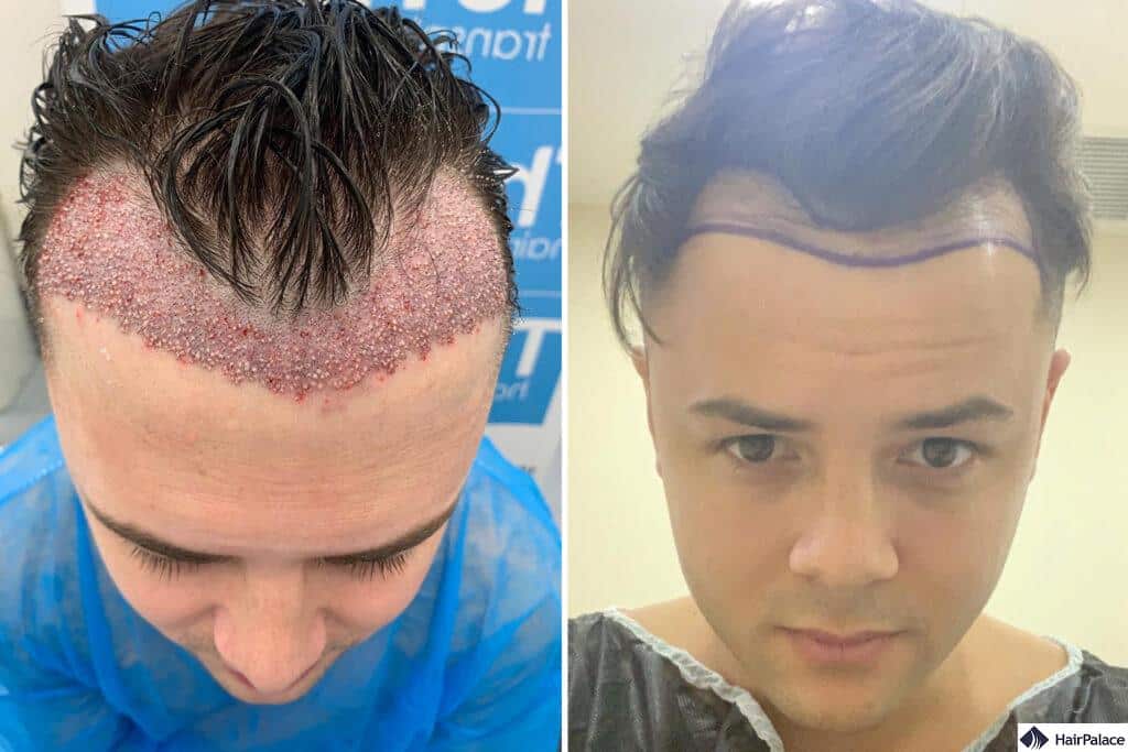 an unnatural hairline is a major sign of a hair transplant gone wrong