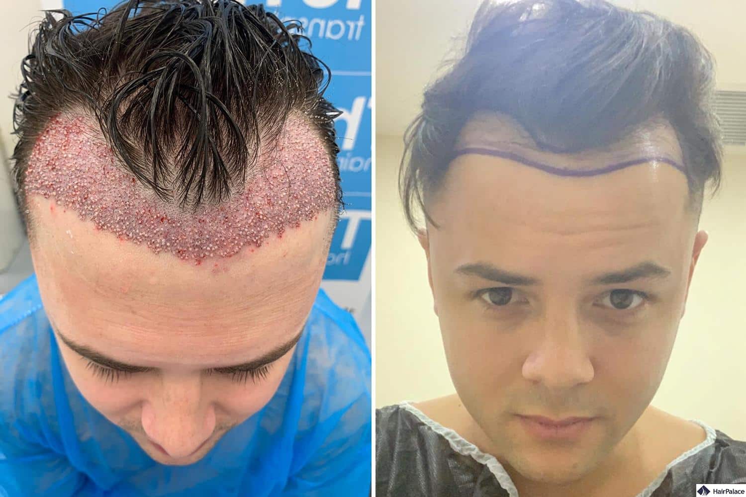 Bad hair transplant