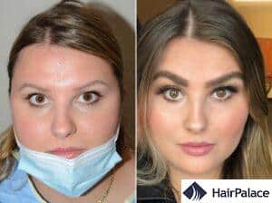 Eyebrow Transplant: Procedure, Costs and Results