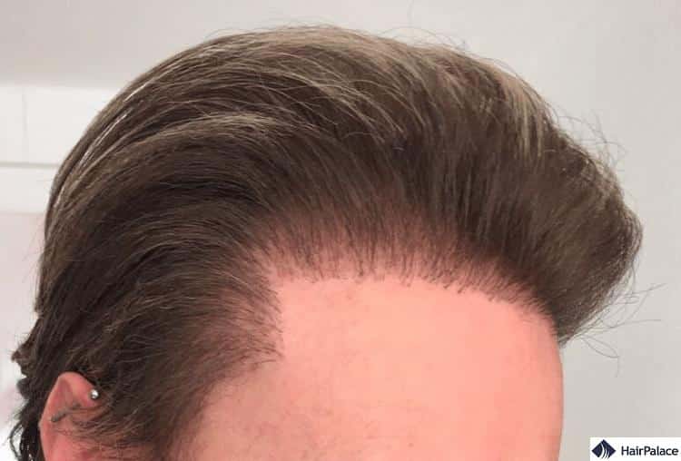 Failed Hair Transplant Can You Avoid or Fix It  DR Emrah CINIK