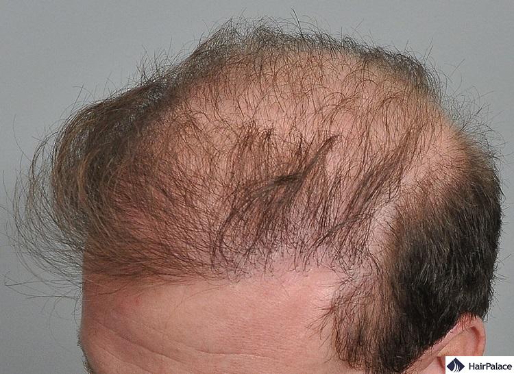 5 Reasons Why Hair Transplants Fail  What Is The Success Rate