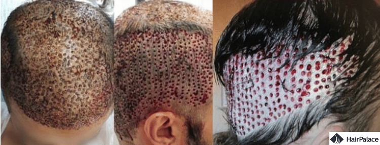 hair transplant scarring