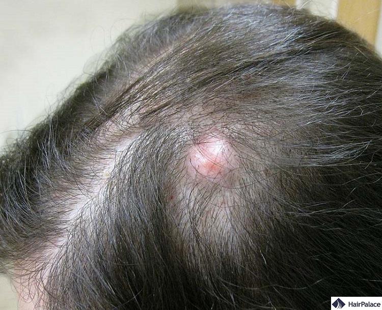 cysts are a dangerous hair transplant side effect