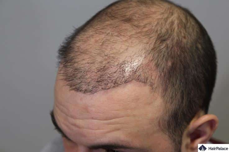 Hair Transplant Gone Wrong | A Look at the Biggest Risks