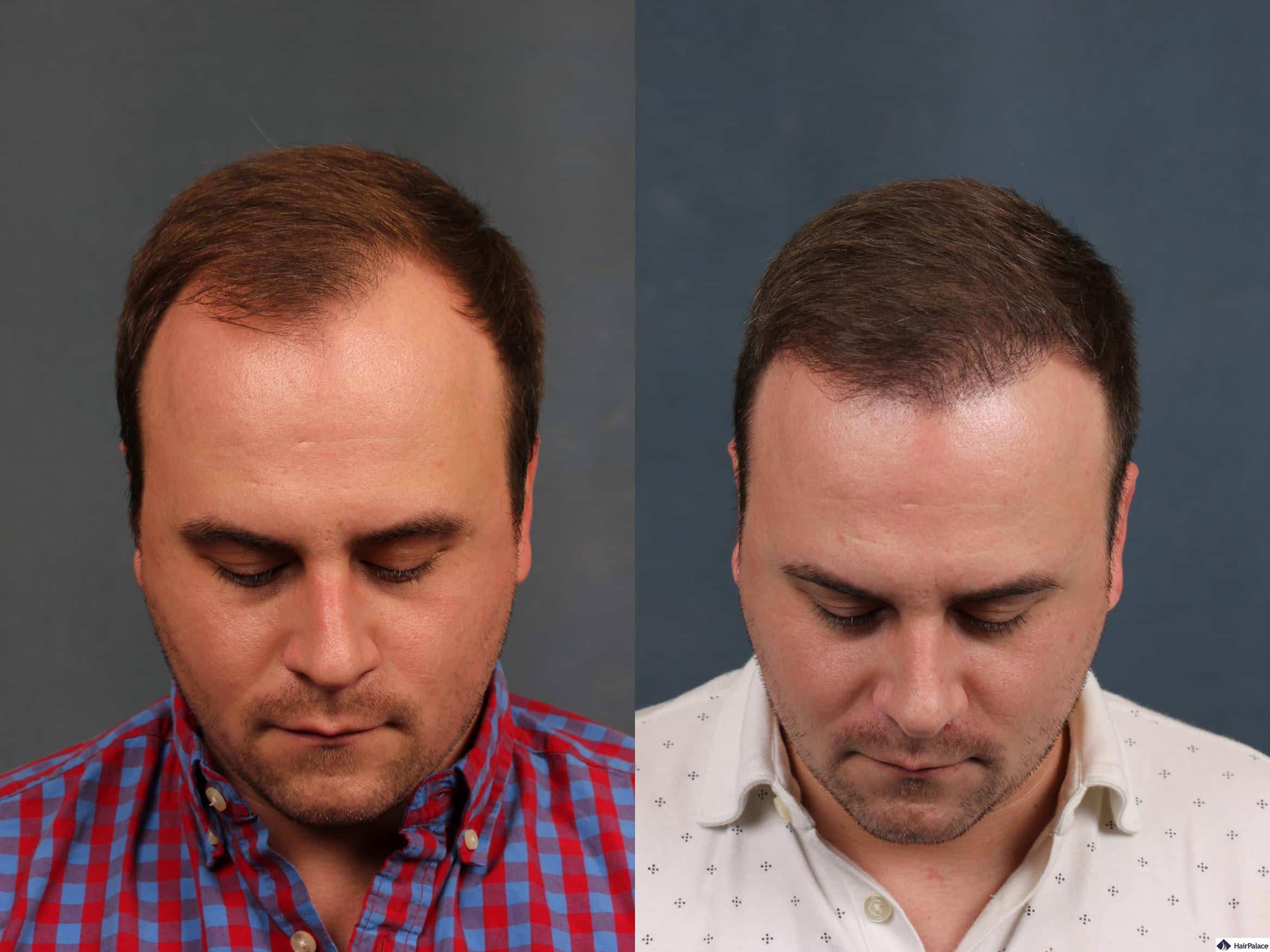 A neograft hair transplant can lead to excellent results