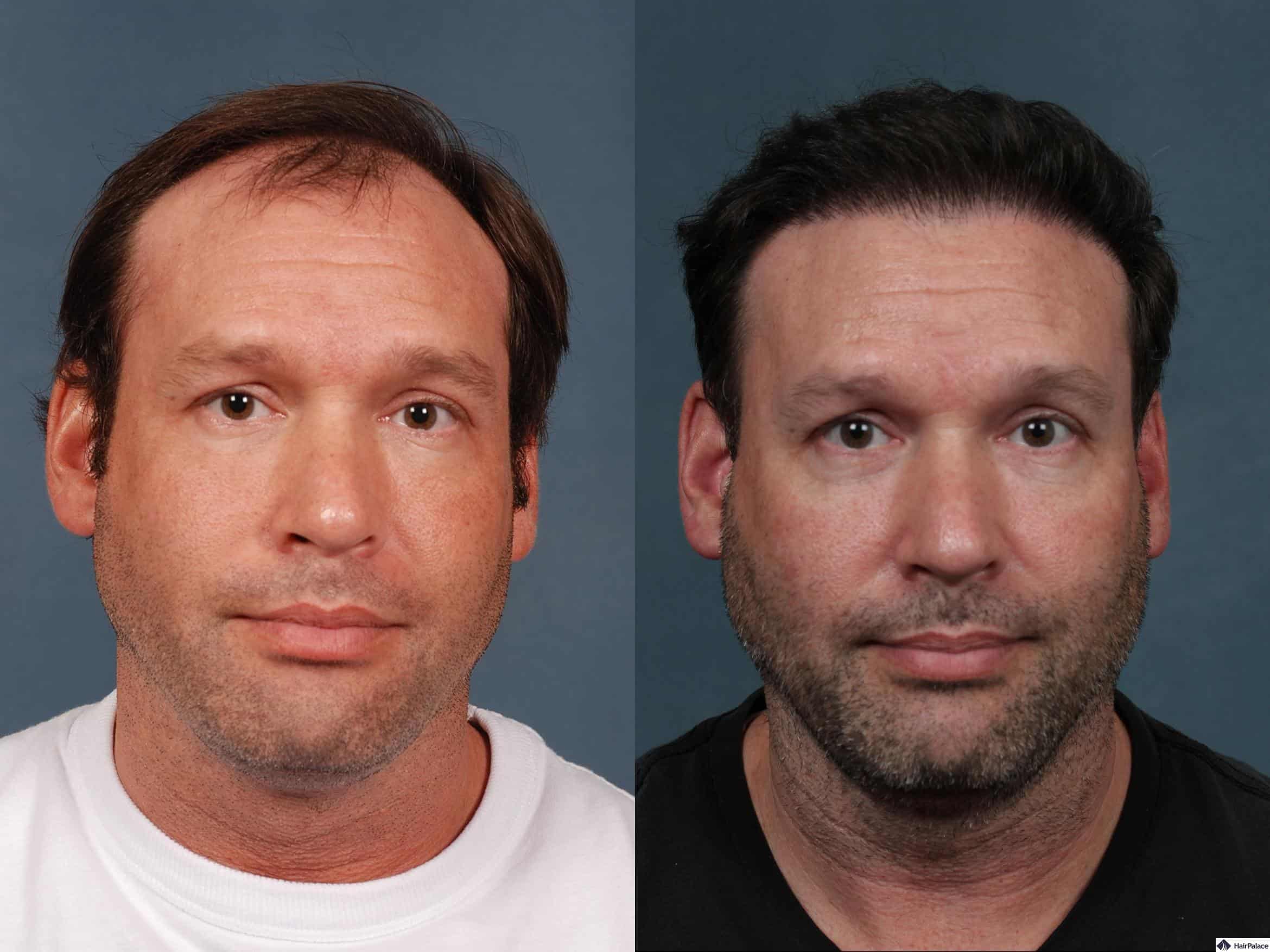Neograft before and after