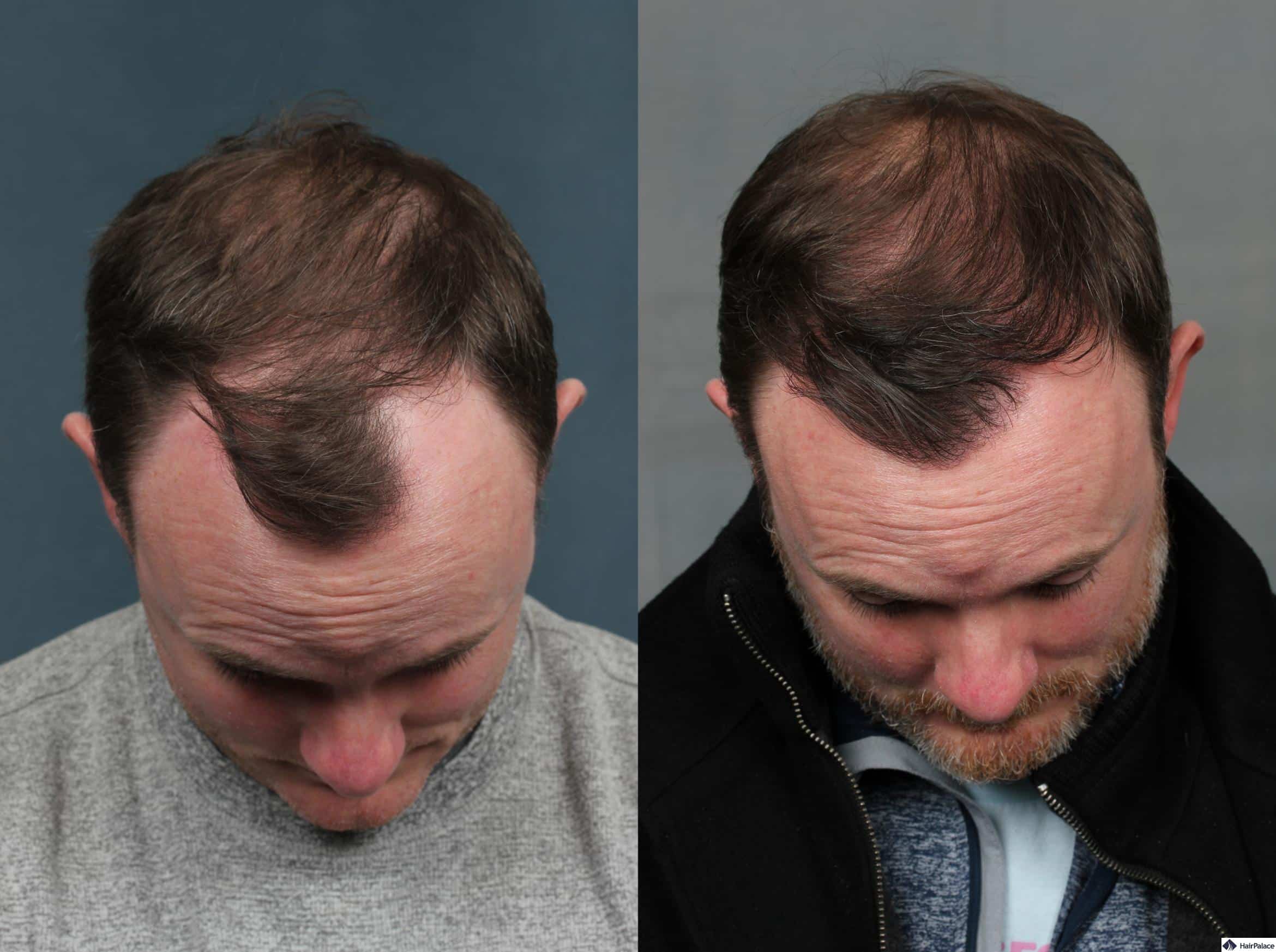 neograft hair restoration