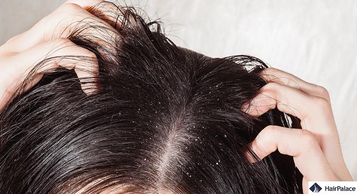 scalp infection hair loss