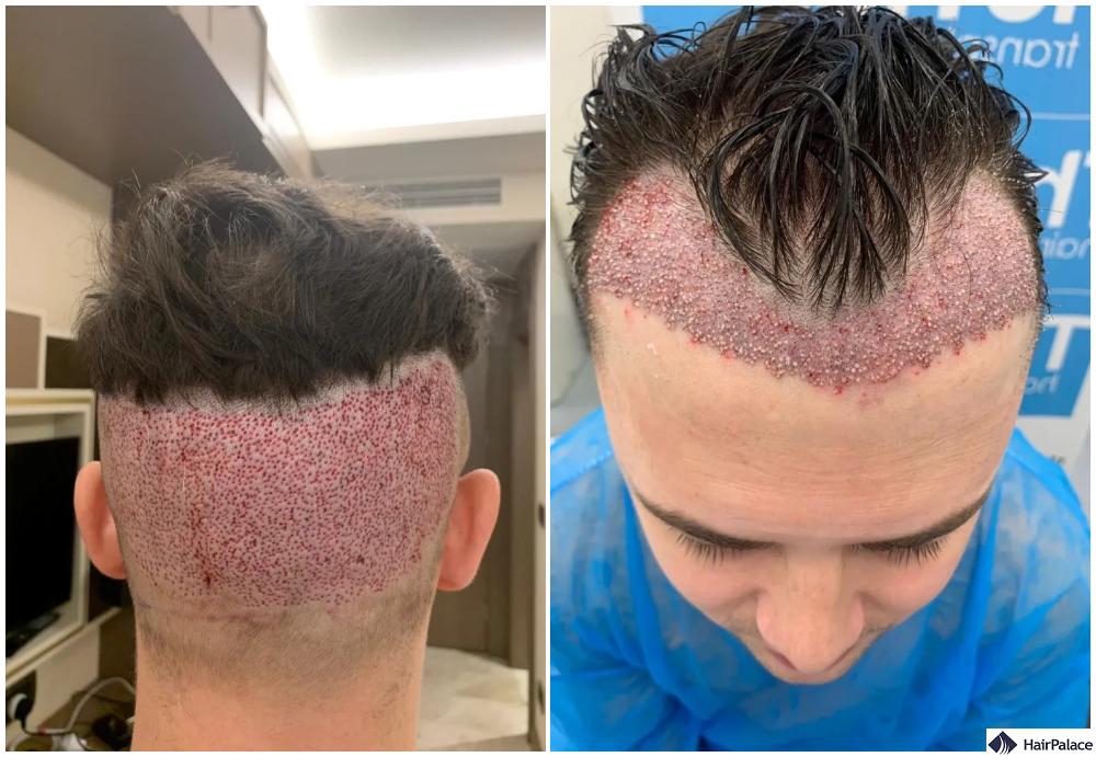 turkey hair transplant fail