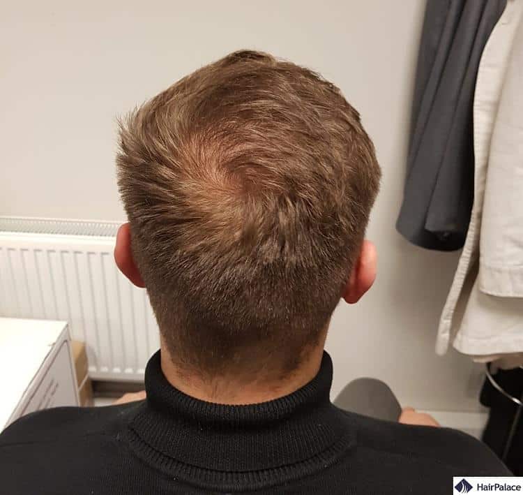 crown hair transplant final result