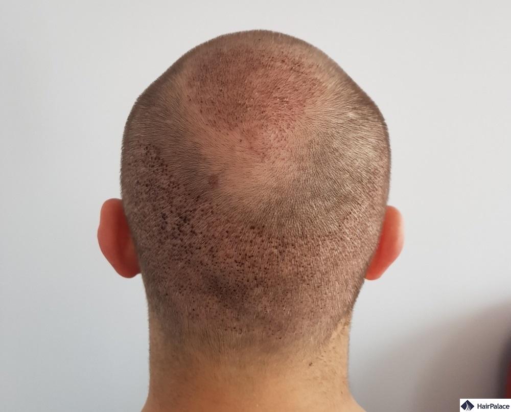 crown hair transplant after one week