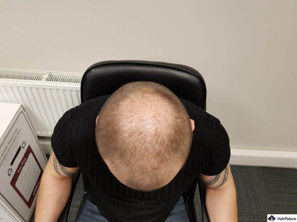 crown hair transplant after three months
