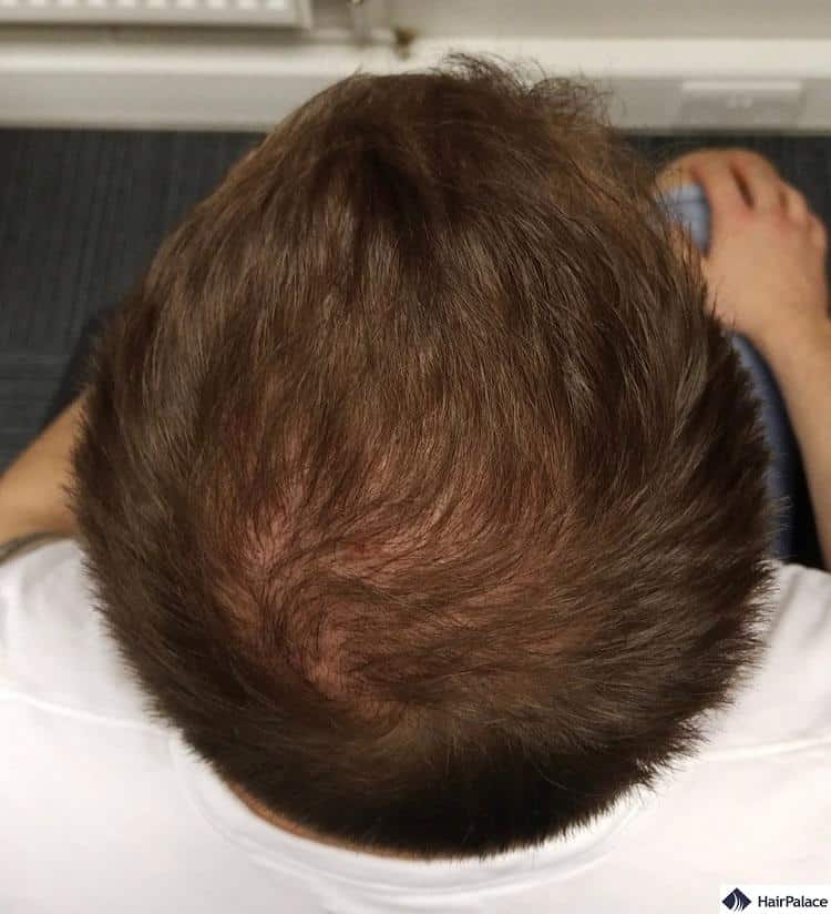 crown hair transplant after 6 months