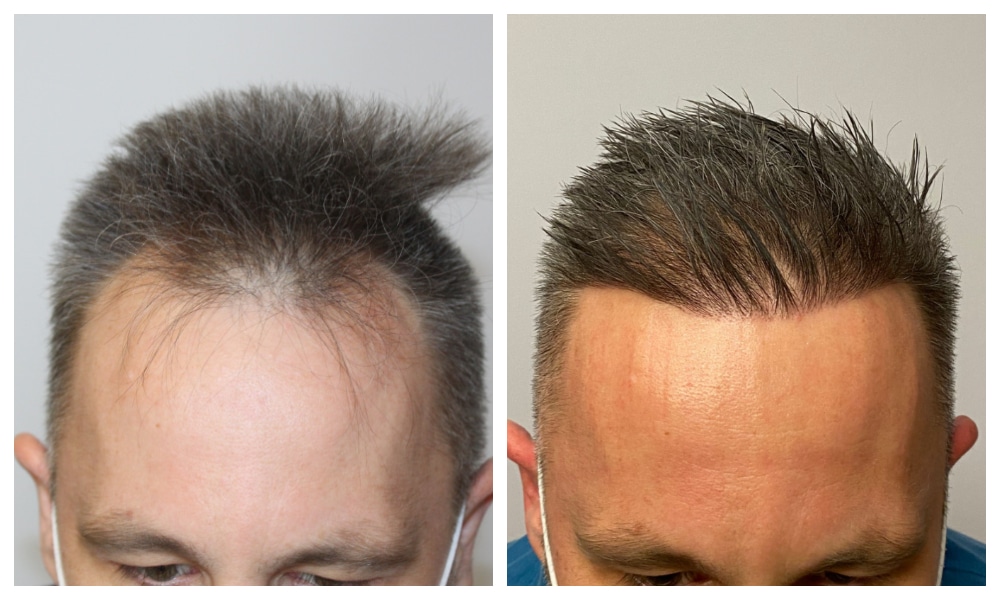 Hair Transplant Before and After - TOP 10 Pictures in 2023