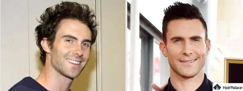 adam levine hair transplant before and after