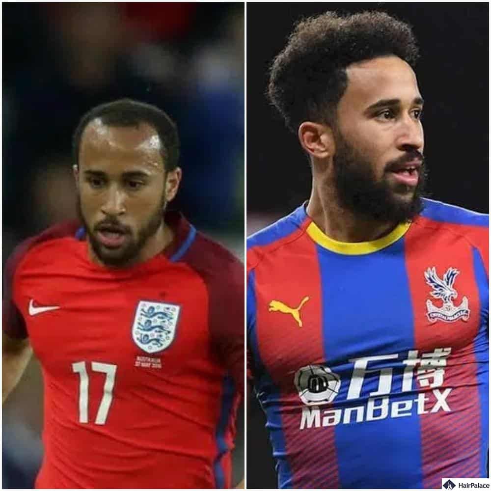 Andros Townsend hair transplant before and after