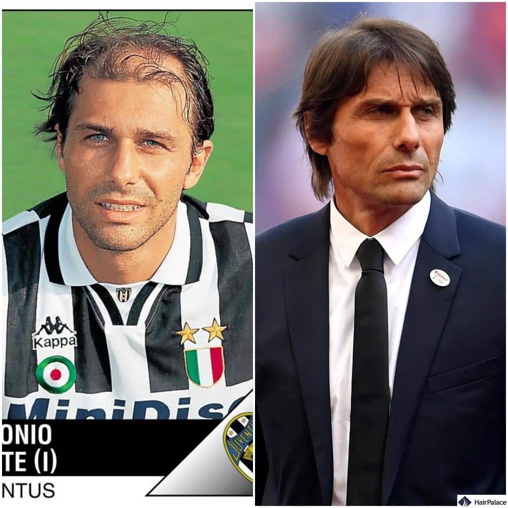 Antonio Conte hair transplant before and after
