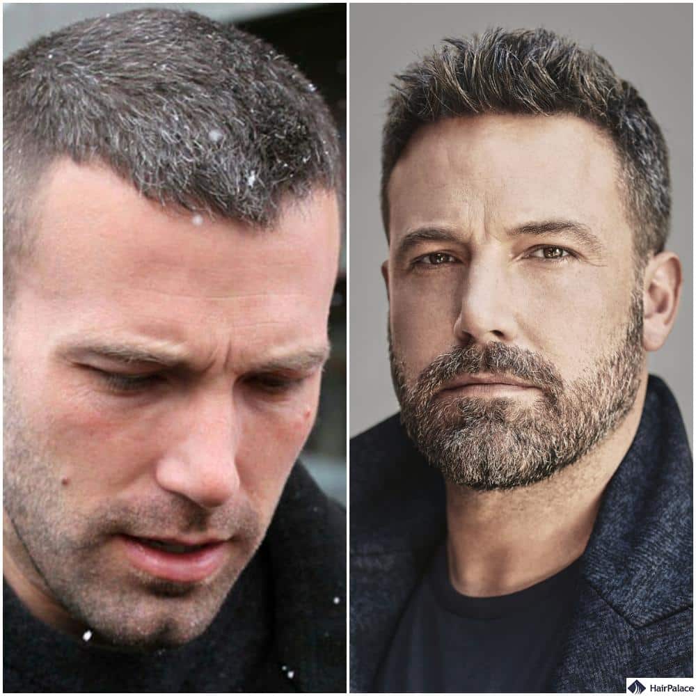 Ben Affleck hair transplant before and after