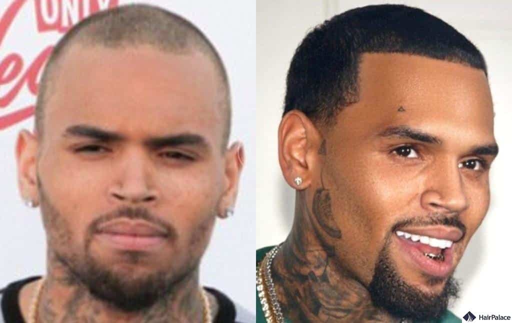chris brown hair transplant before and after