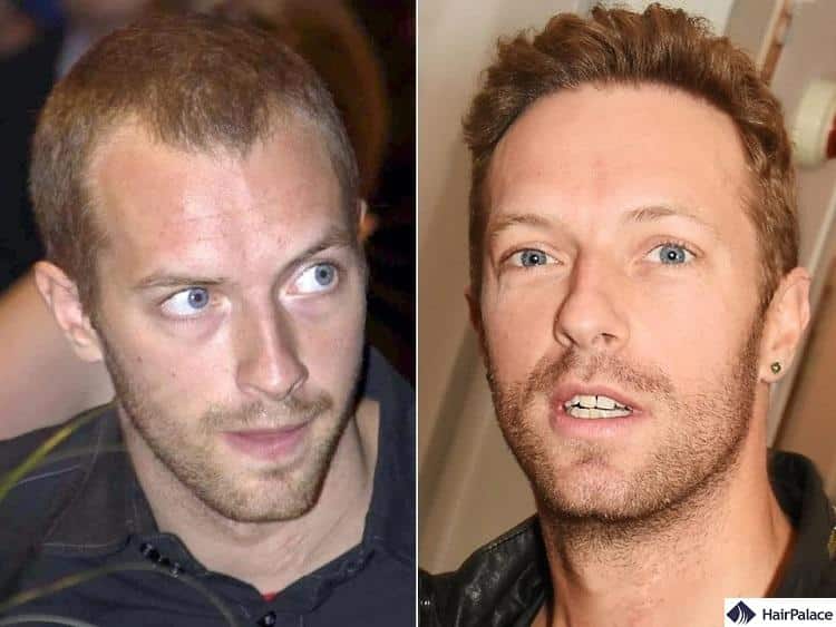 chris martin hair transplant before and after