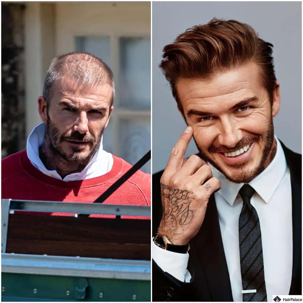David Beckham hair transplant before and after