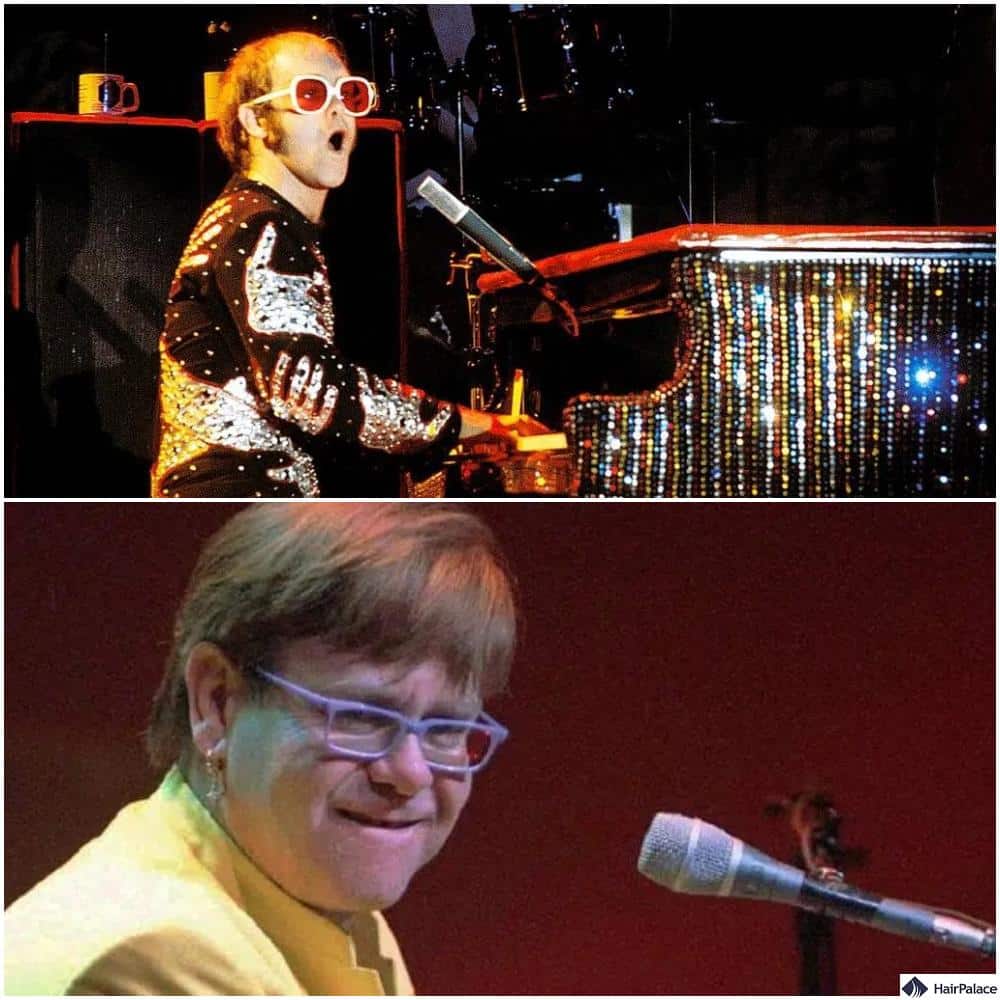 elton john hair transplant before and after