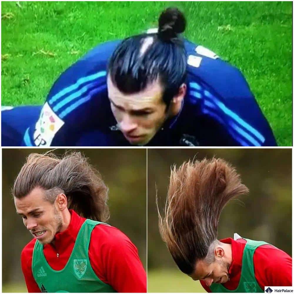 Gareth Bale hair transplant before and after